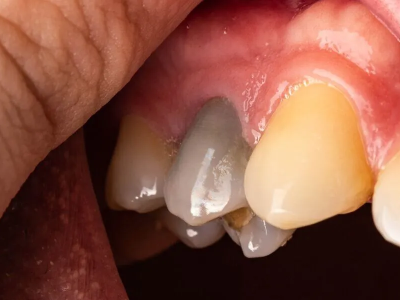 how long can a dead tooth stay in your mouth