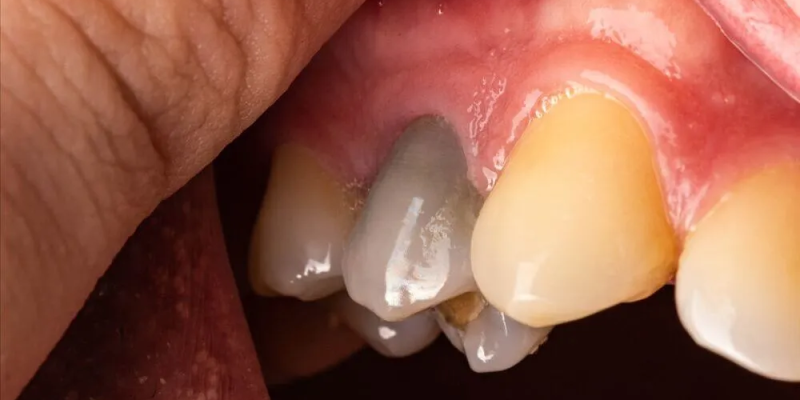 how long can a dead tooth stay in your mouth