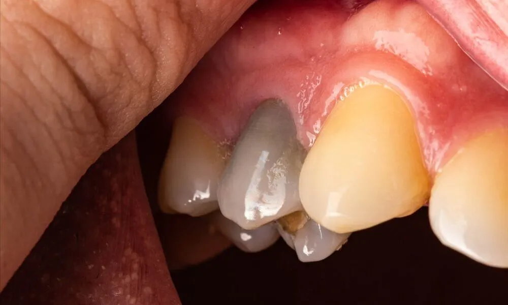 how long can a dead tooth stay in your mouth